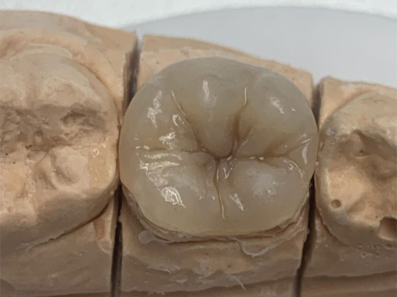 Fixní kompozitní onlay