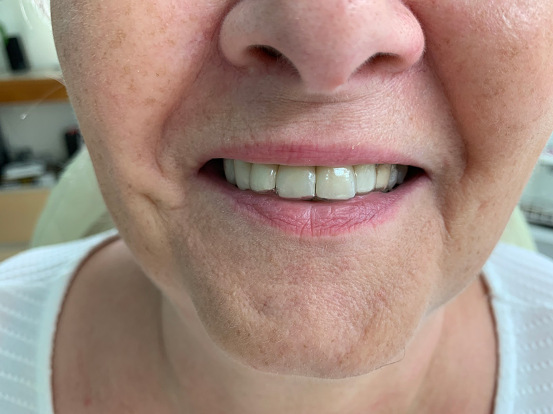 Foliový můstek pro zub 21