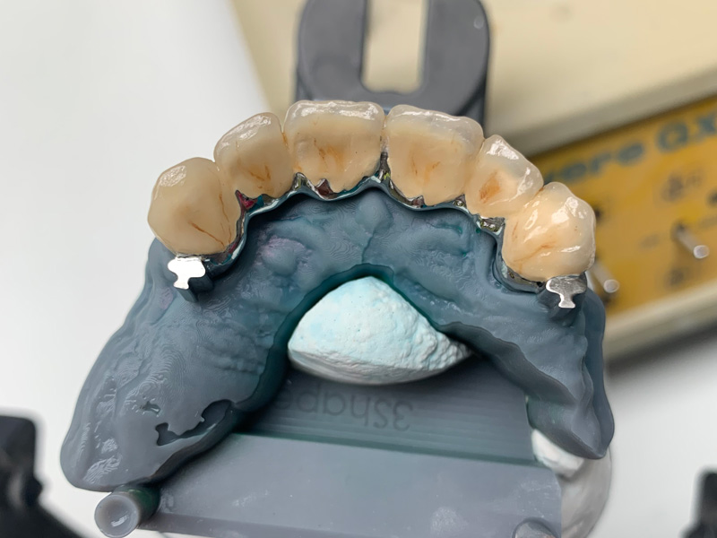 Kombinovaná práce - metalokeramika