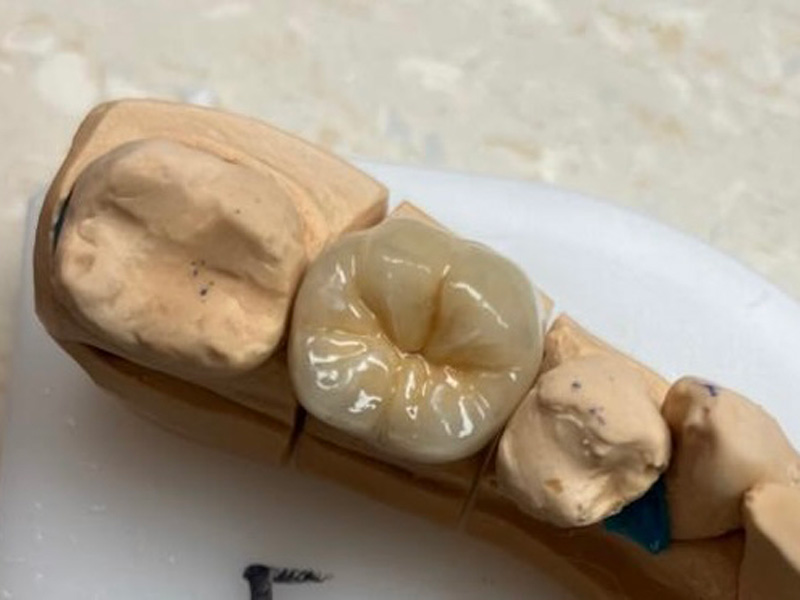 Metalokeramická korunka