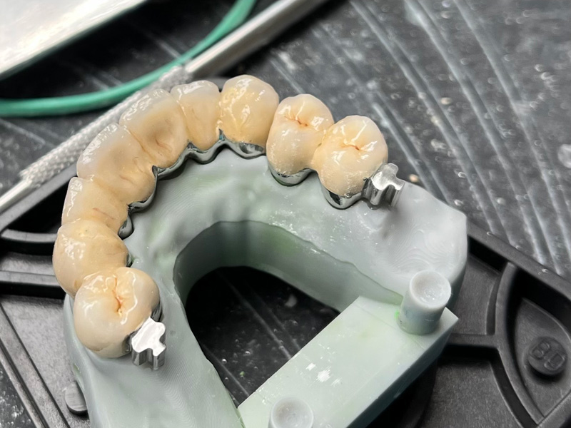 Metalokeramický můstek - Kombinovaná práce