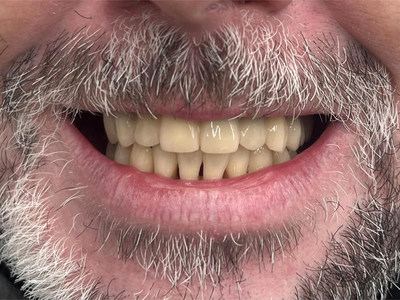 Provizorní můstek horní čelist PMMA