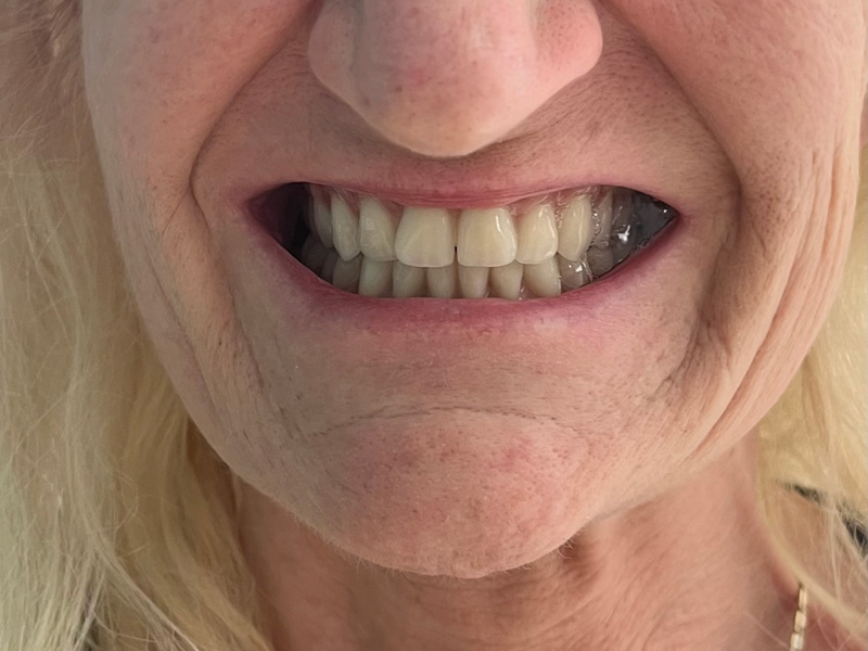 Stav po protetickém ošetření