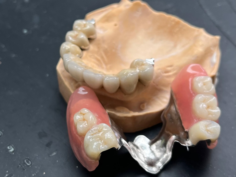 Kombinovaná práce - metalokeramický můstek skelet