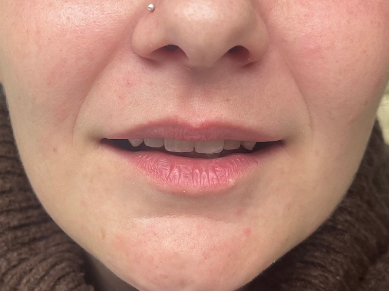 Stav po protetickém ošetření