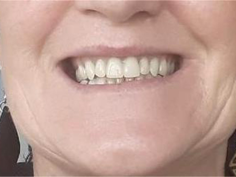 Stav po protetickém ošetření