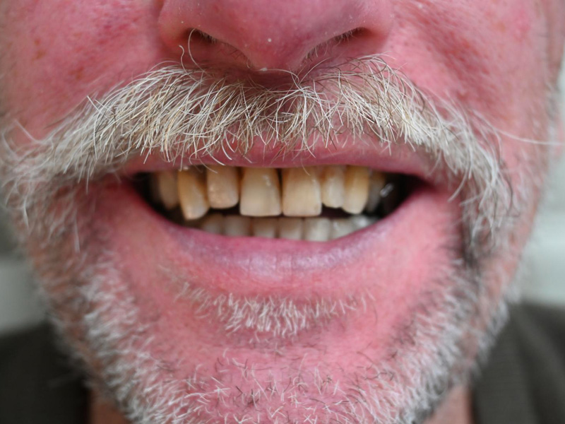 Stav po protetickém ošetření