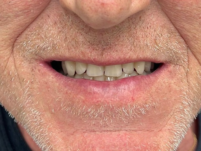 Snímatelná nadstandardní CSN