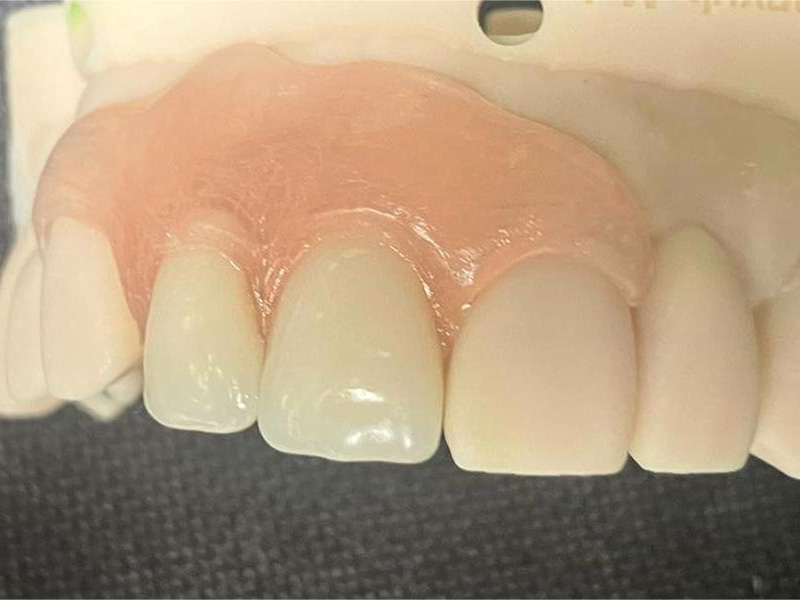 Snímatelný deflex mezerník